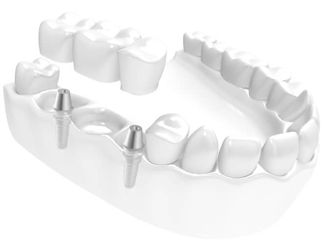 2 implantat med 3-ledds implantatbro kan erstatte tre manglende tenner ved siden av hverandre