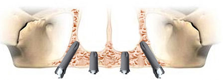 Illustrasjon av All-on-4-implantat i overkjeve