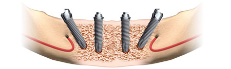 Illustrasjon av All-on-4-implantat i underkjeve