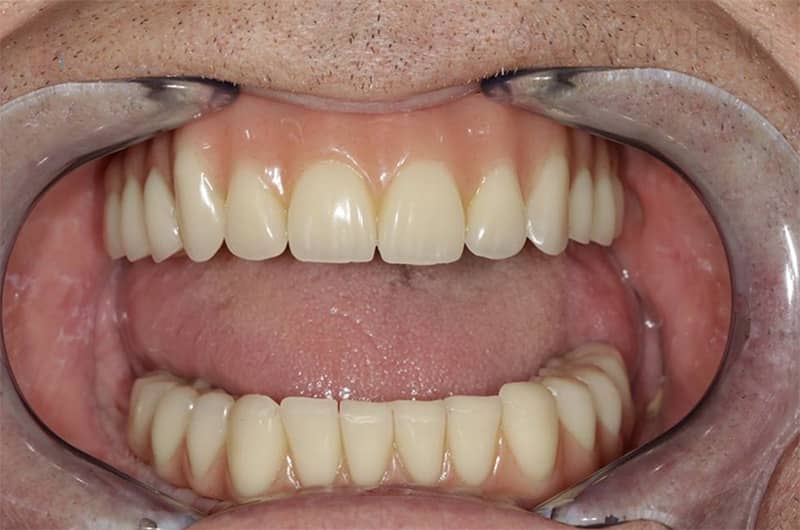 Implantatbroer skrudd fast i pasientens munn
