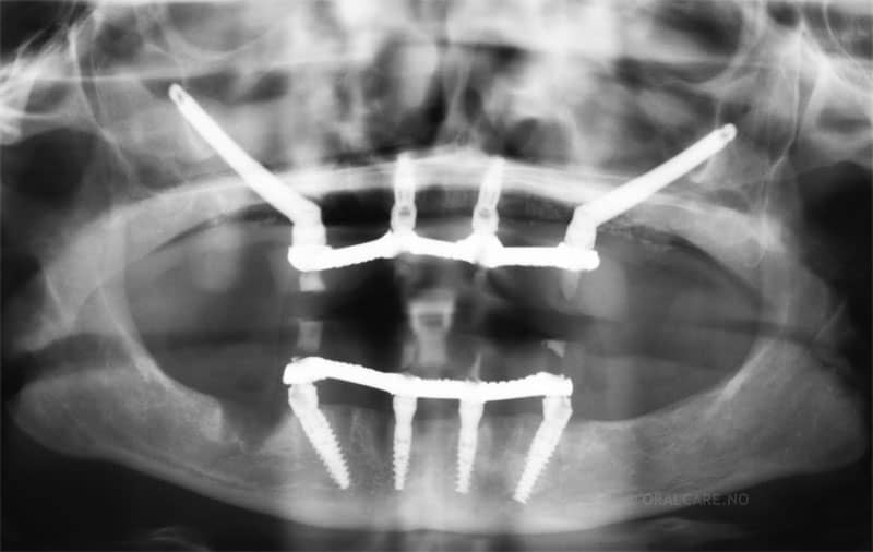 OPG-røntgenbilde etter implantatbehandling